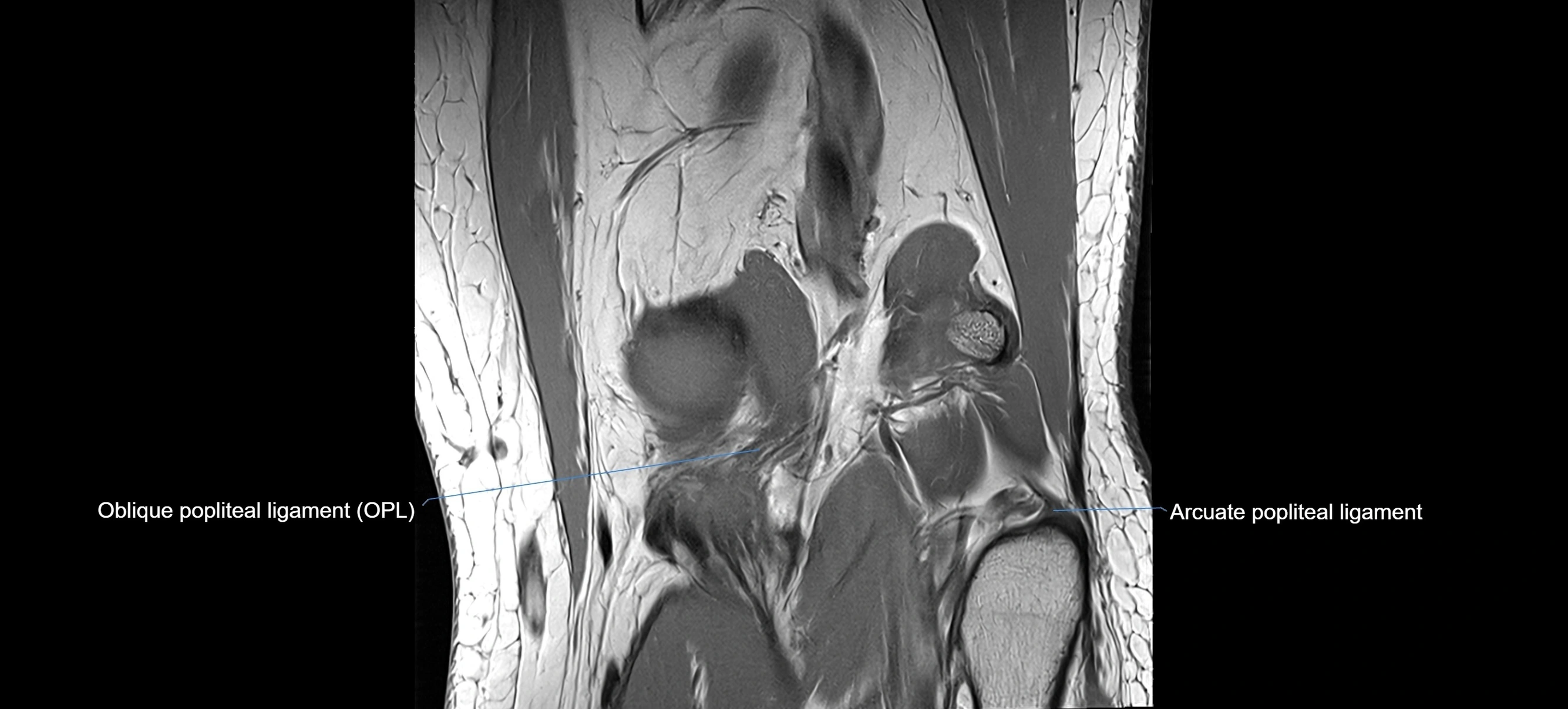 MRI coronal  ligaments cross sectional anatomy 3T  radiology  image-img-04001-00030.webp